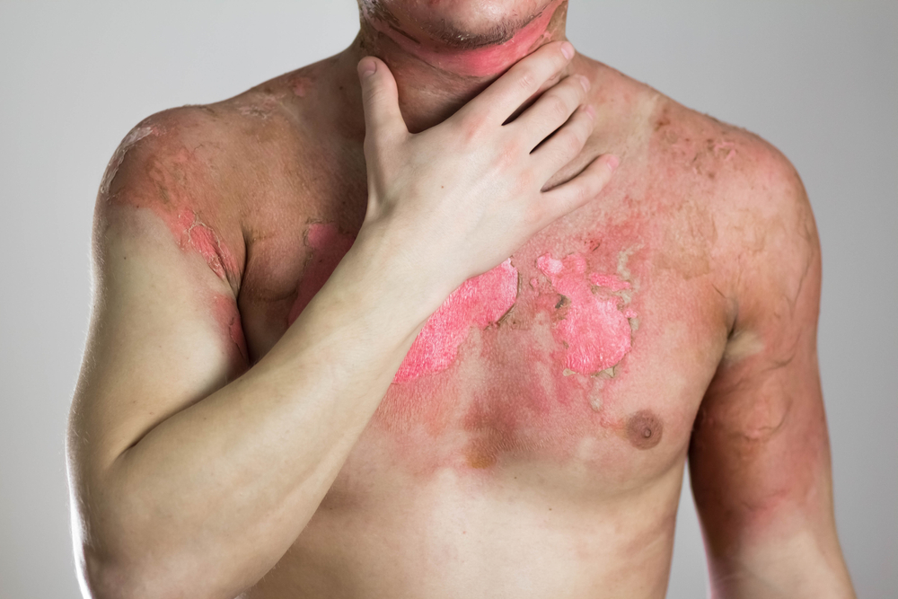 Evansville Burn Injury Lawyer