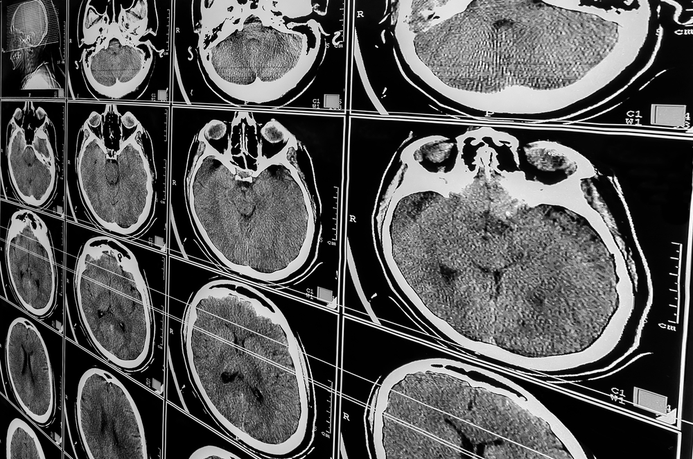 Fort Wayne Traumatic Brain Injury Lawyer